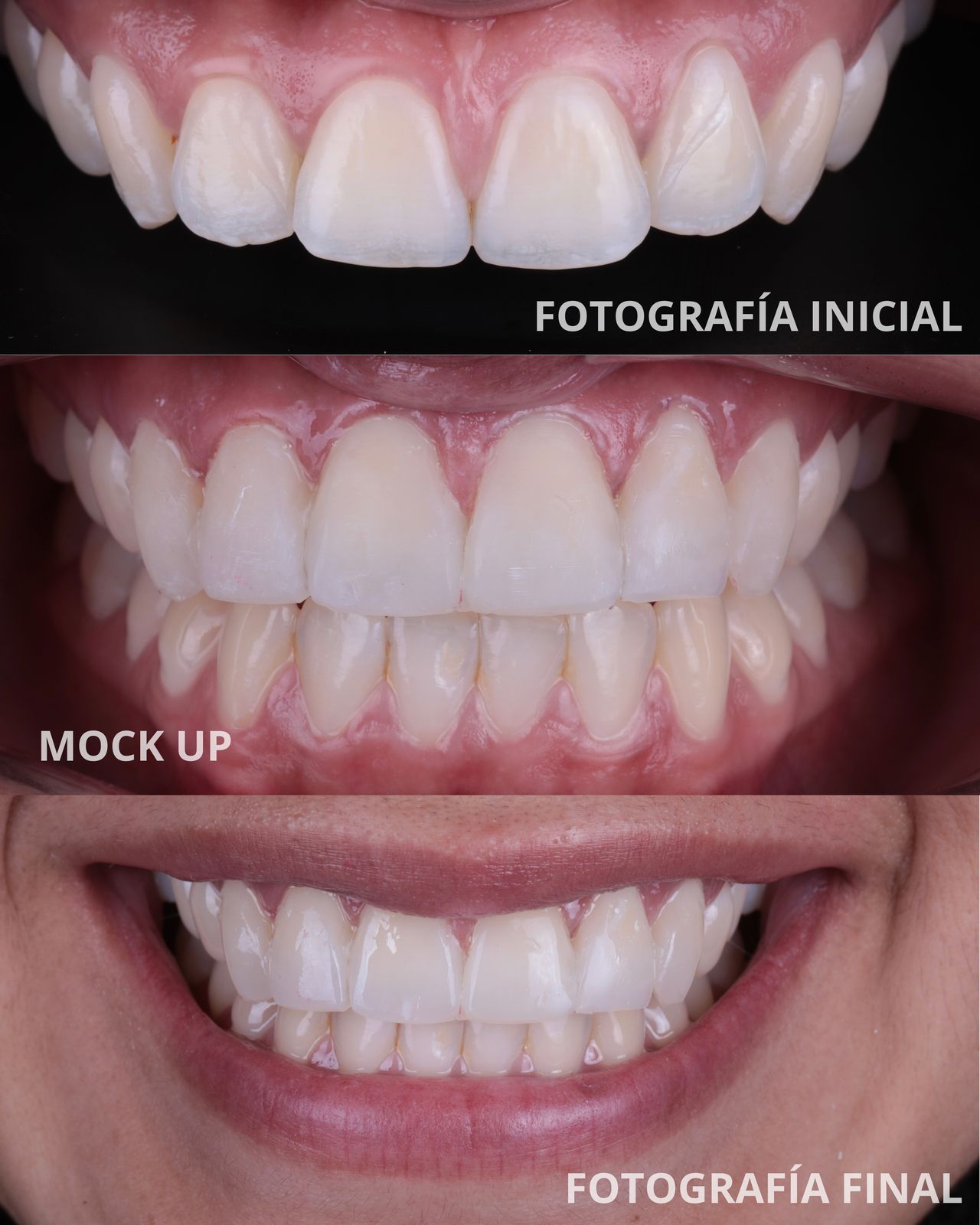 Diseño de sonrisa: Inicial · mock up · final