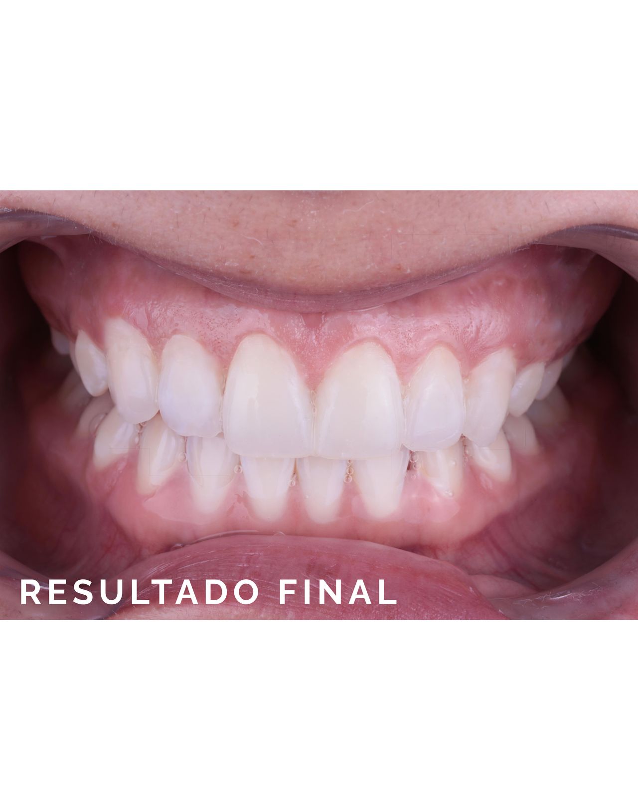 Resultado final: Sonrisa natural