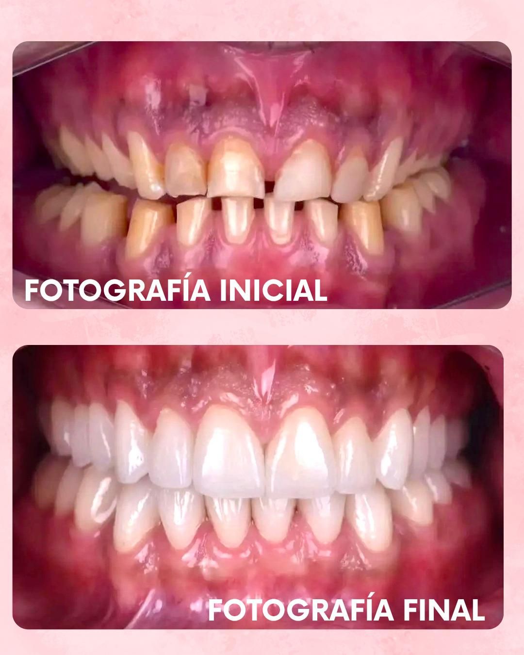 Carillas: Antes y después