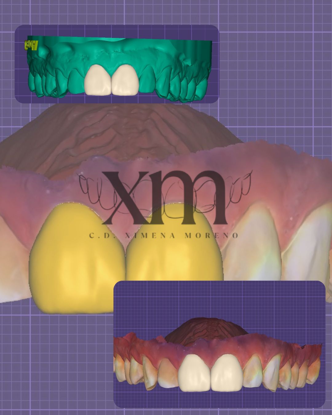 Coronas en 3D: Escáner intraoral e impresión 3D